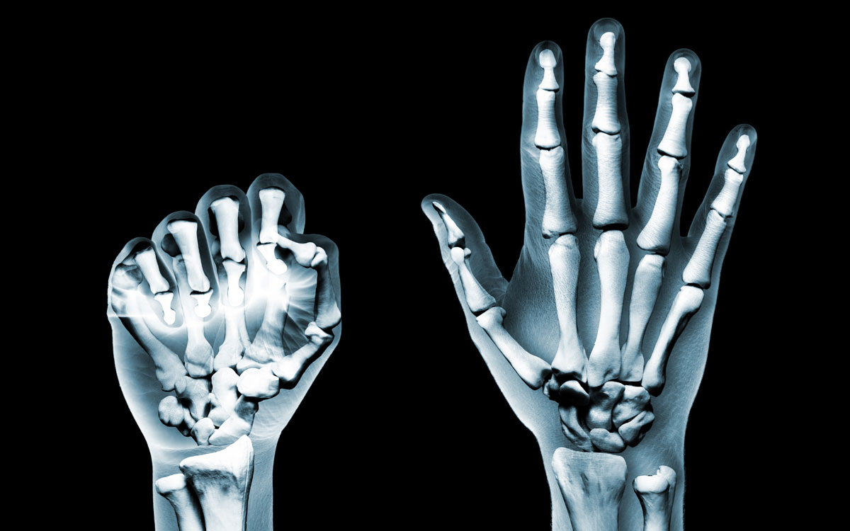 Daily rheumatic complaints in the finger joints