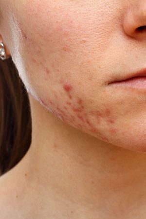 An acne-prone facial skin.
