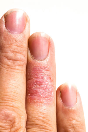 A skin prone to ecm / eczema.