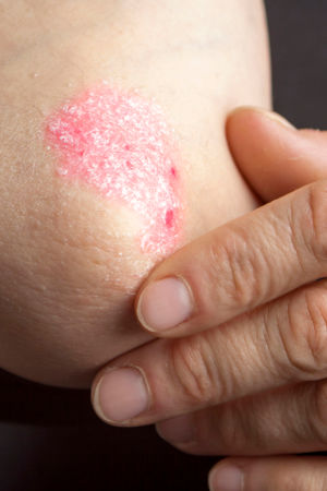 Psoriasis a disease of the skin